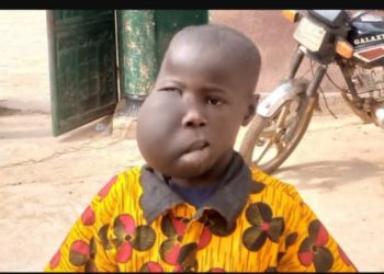 N’Zérékoré : l’appel déchirant d’une mère pour sauver son fils atteint d’une tumeur à la tête