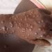 Urgent/santé: La Guinée confrontée à plusieurs épidémies dont Mpox (ANSS) 10 Urgent/santé: La Guinée confrontée à plusieurs épidémies dont Mpox (ANSS)