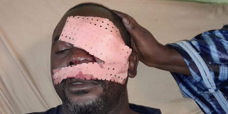 Violemment agressé par des jeunes en furie, le journaliste Daouda Bah perd un œil à Bomboli. 1 Violemment agressé par des jeunes en furie, le journaliste Daouda Bah perd un œil à Bomboli.